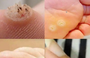 Be Very Careful: If You Notice This Skin Growth, It Could Be Serious