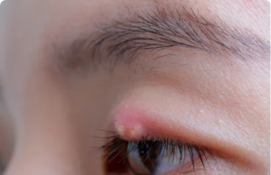 Say Goodbye to Eye Styes: Discover natural remedies to relieve discomfort and speed healing