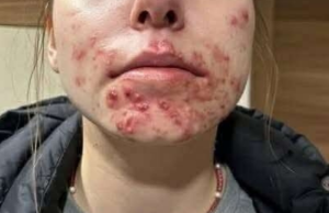 What Your Skin Might Be Telling You: The Hidden Meaning Behind Livedo Reticularis