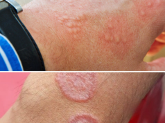 Signs of Groin Skin Irritation: Causes, Symptoms, and Gentle Care