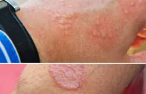 Signs of Groin Skin Irritation: Causes, Symptoms, and Gentle Care