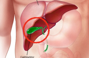 Life After Gallbladder Removal: Honoring Your Bodyâs Quiet Wisdom