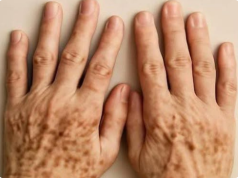 Dark Spots on the Hands: When to Pay Attention—and When to See a Dermatologist