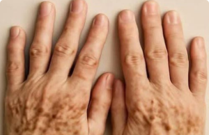 Dark Spots on the Hands: When to Pay Attention—and When to See a Dermatologist