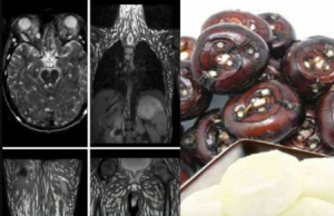 ONE BITE IS ALL IT TAKES: The Silent Parasite Crisis Hiding in Your Everyday Meals