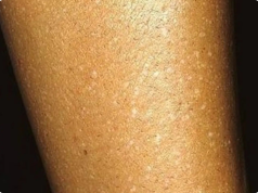 Those Mysterious White Spots on Your Arms and Legs? Here’s What They Really Are—and Why You Likely Don’t Need to Worry