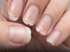 Weak or Brittle Nails: What Your Body Is Trying to Tell You