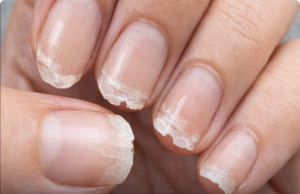 Weak or Brittle Nails: What Your Body Is Trying to Tell You