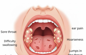 What Symptoms Does HPV Cause in the Throat? Understanding the Signs and Risks