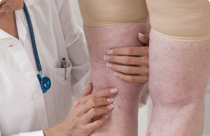 Blood Clots: 7 Silent Warning Signs You Should Never Ignore