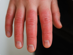 My hands burn and turn red after being in the cold, but I can’t see a doctor anytime soon. What should I do now?