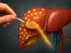 One Teaspoon a Day May Help Reverse Fatty Liver—Naturally